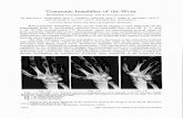 Traumatic Instability of the Wrist...Traumatic Instability of the Wrist From the Mayo Clinic and Mayo Foundation, Rochester Post-traumatic instability of the carpus and the zigzag
