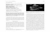 Cardiac Tuberculoma of the Right Atriumecho-research.rhc.ac.ir/Files/Forms/2014-08-03_08.01.45_19.pdfwhich was a tuberculoma without active pulmonary disease. CASE REPORT A 21-year-old