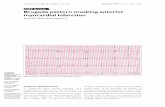 CME Article Brugada pattern masking anterior myocardial ... · Male gender and a family history of sudden cardiac death (SCD) are risk factors for SCD. Patients with a history of
