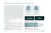 Solitary clavicle metastasis in prostate carcinoma M Y K C · 5. Ansari MS, Nabi G, Aron M. Solitary radial head metastasis with wrist drop: a rare presentation of metastatic prostate