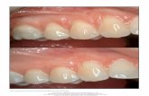 The International Journal of Periodontics & Restorative ... · antibiotics to prevent complications after periodontal surgery,26–29 and the value of periodontal dress-ings30–32