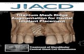 Titanium Mesh Ridge Augmentation for Dental Implant Placement · Implant Placement: A Case Report Dr. Lanka Mahesh1 • Dr. Dildeep Bali2 Dr. Vishal Gupta 1 • Dr. Taran Preet Singh1