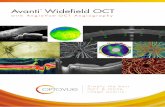Avanti Widefield OCT - Clarion Medical Technologies...brochure. Unless noted, all images are courtesy of Adil El Maftouhi. Small Incision Lenticule Extraction (SMILE) Surgery Visualize