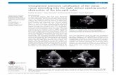 Unexplained extensive calciﬁcation of the venae …...Unexplained extensive calciﬁcation of the venae cavae extending into the right atrium causing partial obstruction of the tricuspid