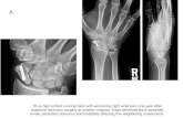 A. · A. 16 yo high school running back with worsening right wrist pain one year after scaphoid nonunion surgery at another hospital. Xrays demonstrate a loosened