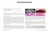 Ectopic pancreas: a very unusual intestinal massscielo.isciii.es/pdf/diges/v110n2/en_1130-0108-diges-110-02-00127.pdf · intestinal mass Key words: Ectopic pancreas. Subepithelial