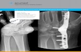 Total Wrist Fusion Plating System - Acumed · Case Study | William Geissler, MD The remaining four 2.3 mm distal locking screws are placed Anterior posterior radiograph Lateral radiograph