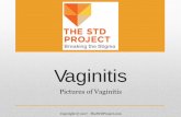 Vaginitis€¦ · THE STD PROJECT Breaking the Stigma . Title: Chancroid Author: Do Not Use Created Date: 8/14/2017 12:45:47 PM