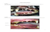 Grades of Dental Disease - Ralston VetGingivitis is the inflammation of the gums, just above or below the teeth. Grade 2 Moderate amount of dental calculus and gingivitis. You may