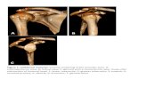 Volume rendering of the shoulder joint. A: anteroposterior …...anatomy of the shoulder. PD-weighted sections obtained with 3 Tesla device. PD-weighted sections obtained with 3 Tesla