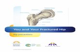 You and Your Fractured Hip - hgsitebuilder.com€¦ · • to reduce the amount and intensity of your pain. • to help you enjoy greater comfort while you exercise and heal. •