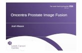 Oncentra Prostate Image Fusion - BrachyAcademy · Image fusion applications (cont) mp-MRI fusion: T2-DWI. Focal GTV delineation - DWI. Focal GTV delineation - DCE. Joshua.Mason@leedsth.nhs.uk