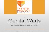 Genital Warts€¦ · THE STD PROJECT Breaking the Stigma . virus . Title: Chancroid Author: Do Not Use Created Date: 8/14/2017 12:29:25 PM