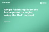Single-tooth replacement in the posterior region using the ...€¦ · Single-tooth replacement ... advantages from a biological and biomechanical ... The patient requires an implant-supported