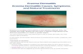 Eczema Dermatitis Eczema Dermatitis Causes, Symptoms, and …medicalexposedownloads.com/PDF/Eczema Dermatitis Causes... · 2017. 10. 23. · Eczema Dermatitis 1 Eczema Dermatitis