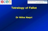 Tetralogy of Fallot · Tetralogy of Fallot - classic Pathophysiology of presentation Large unrestrictive VSD - equal ventricular pressures RV-PA outflow obstruction – high RV-PA