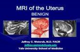 MRI of the Uterus - Scbtmr Jef… · pelvic endometriosis and uterine adenomyosis as variants of the same disease process • Adenomyosis used to be know as “endometriosis interna”