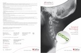 Techniquesynthes.vo.llnwd.net/o16/LLNWMB8/INT Mobile/Synthes... · 2015. 1. 16. · The UNIPLATE® 2 Anterior Cervical Plate System is designed to simplify anterior cervical fusions