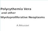 Polycythemia Vera and other Myeloproliferatirozup.ir/download/1573670/Polycythemia Vera and Other... · 2016. 5. 26. · Hypermetabolism symptoms . Diagnosis Easy with erythrocytosis