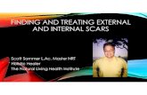 FINDING AND TREATING EXTERNAL AND INTERNAL SCARS Internal... · KEYS TO SCARS 1. your body electric -meridians and skin 2. how scars interfere -switching Sxs 3. finding scars defined