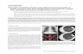 The case of double primary lung adenocarcinomas with an … · 2019. 4. 19. · kinase and ALK inhibitors for EML4-ALK-rearranged non-small-cell lung cancer harbored coexisting EGFR