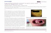 vsfsnbupmphomof Letter to the Editor Lipoid Proteinosis ... · develop acneiform or pock-like scars on the face either spontaneously or due to trauma. In this article, we describe