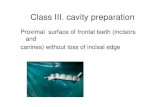 Proximal surface of frontal teeth (incisors and canines ...Class III. cavity preparation Proximal surface of frontal teeth (incisors and canines) without loss of incisal edge. Access