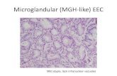 Microglandular (MGH-like) EEC · 2020. 10. 18. · MGH-like EEC vs. MGH MGH-like EEC • Endometrial • Merging with EEC/MC, hyperplasia, morules, foam cells, endometrial tissue*