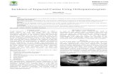Incidence of Impacted Canine Using Orthopantomogram · Incidence of Impacted Canine Using Orthopantomogram Abstract: Aim The aim of the present study is to evaluate the inci dence