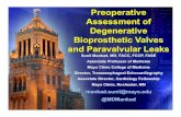Preoperative Assessment of Degenerative ... · bioprosthetic mitral valve replacement in 2003 for endocarditis –Required re-operation for bleeding • Underwent redo MV replacement