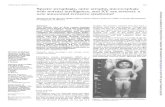 Spastic microcephaly intelligence, · and without involvement of the SRY gene, whichis implicated in maledifferentiation.'1-13 We report two sisters of consanguineous parents with