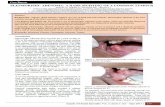 annalsofdentalspecialty.net.in...as Irritational fibroma due to its site of presentation and histologically was diagnosed as pleomorphic adenoma. The case has been followed up for