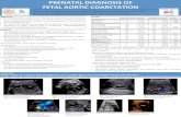 PRENATAL DIAGNOSIS OF FETAL AORTIC COARCTATION• Prenatal diagnosis of fetal aor/c coarctaon ( AoCo) is mainly suspected when cardiac ventricular or great vessels dispropor/on is