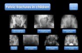 Pelvic fractures in children Help for Childrenemergencymedicine101.com/wp-content/uploads/2020/09/... · 2020. 9. 15. · Pelvic fractures in childrenPelvic fractures in children