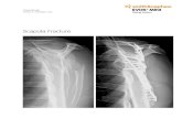 Scapula Fracture - Smith & Nephe · 2015. 11. 16. · scapula. Preoperative CT scan confirms the significant displacement of the glenoid fragment involving approximately 40% of the