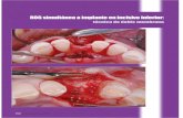 ROG simultánea a implante en incisivo inferior · 2012. 7. 19. · Periodoncia e Implantes en Córdoba. 170 MAXILLARIS, septiembre 2009 Ciencia y práctica de la cresta (figs. 4