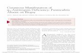 Jenna L. Streicher, MD; Michael P. Sheehan, MD; Andrew B ......1-antitrypsin (AAT) deficiency may develop cutaneous manifestations of the disorder that histologically appear as panniculitis.