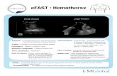 eFAST : Hemothorax