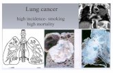 Lung cancer - u-szeged.hu