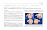Neutrophilic Dermatosis of the Palms in Association with ...