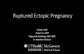Ruptured Ectopic Pregnancy