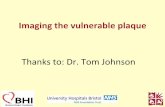 Imaging the vulnerable plaque