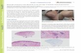 Plaque-like Cutaneous Lupus Mucinosis as the First Sign of ...
