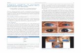 Cataract surgery in juvenile xanthogranuloma: Case report ...