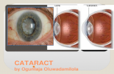 Cataract lecture