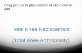Total Knee Replacement (Total Knee Arthroplasty).