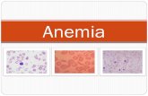 Anemia - Definition of anemia . Epidemiology. Classification. Review the terminology used to discuss