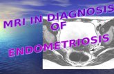 INTRODUCTION ENDOMETRIOSIS is a benign disorder characterised by proliferation of endometrial tissues outside the endometrial cavity. ENDOMETRIOSIS is